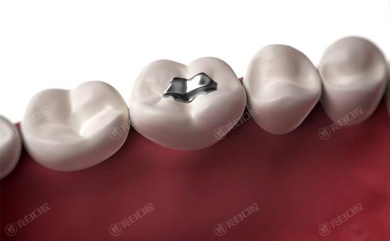 我左邊牙齒根部，牙洞很大，一吃飯就塞。這種情況是必須補牙嗎？